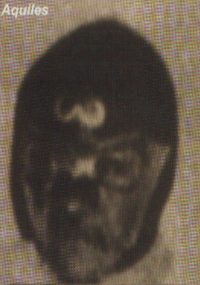 Aquiles